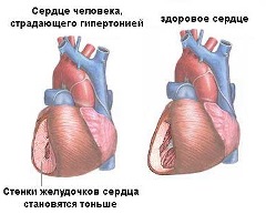 сердце здоровое и сердце человека с гипертонией