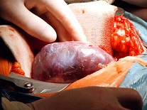  Израиль является лидером в трансплантации органов