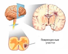 поврежденные участки мозга при рассеянном склерозе, рассеянный склероз