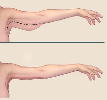 брахиопластика до и после, подтяжка кожи рук
