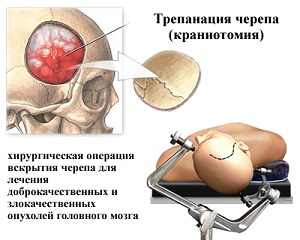 краниотомия, трепанация черепа