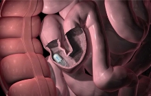 Эндоскопическое исследование тонкого кишечника видеокапсулой