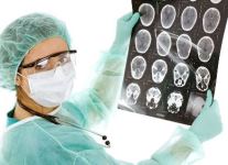  10 интересных фактов о раке головного мозга 