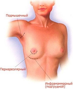 виды разрезов при пластике груди, увеличение груди в израиле