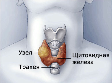Удаление опухоли щитовидной железы в Израиле